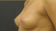 Breast Augmentation