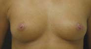 Breast Augmentation