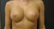 Breast Augmentation