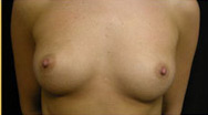 Breast Augmentation