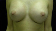 Breast Augmentation