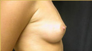 Breast Augmentation