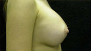 Breast Augmentation