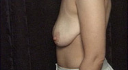 Breast Augmentation