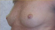 Breast Augmentation