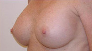 Breast Augmentation