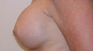 Breast Augmentation