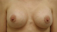 Breast Augmentation