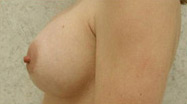 Breast Augmentation