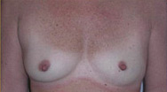 Breast Augmentation