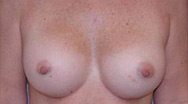 Breast Augmentation