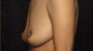 Breast Augmentation