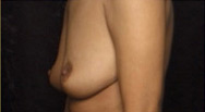 Breast Augmentation