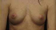 Breast Augmentation