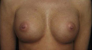 Breast Augmentation