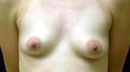 Breast Augmentation