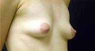 Breast Augmentation