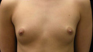 Breast Augmentation