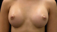 Breast Augmentation