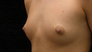 Breast Augmentation