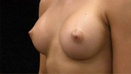 Breast Augmentation