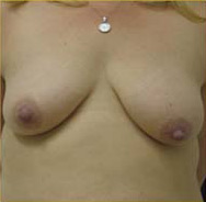 Breast Augmentation