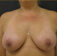 Breast Augmentation