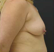 Breast Augmentation