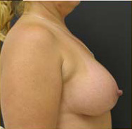 Breast Augmentation