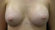 Breast Augmentation