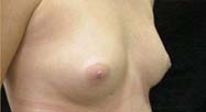 Breast Augmentation