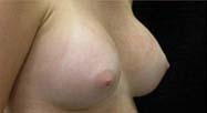 Breast Augmentation