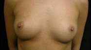 Breast Augmentation