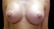 Breast Augmentation