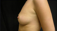 Breast Augmentation