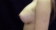 Breast Augmentation Case 3289 After Photo Breast Augmentation
