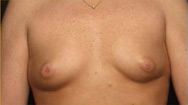 Breast Augmentation