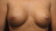 Breast Augmentation