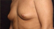 Breast Augmentation