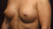 Breast Augmentation