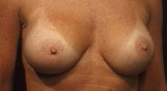 Breast Augmentation