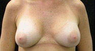 Breast Augmentation