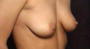 Breast Augmentation