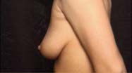 Breast Augmentation