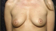 Breast Augmentation