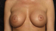 Breast Augmentation