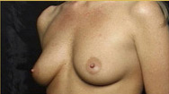 Breast Augmentation