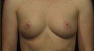 Breast Augmentation