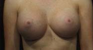 Breast Augmentation