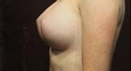 Breast Augmentation